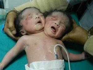 Nace una niña con dos cabezas en La India