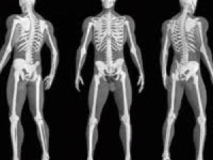 Científicos turcos desarrollan gel para curar las fracturas óseas